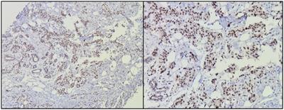 Association of hTERT expression, Her2Neu, estrogen receptors, progesterone receptors, with telomere length before and at the end of treatment in breast cancer patients